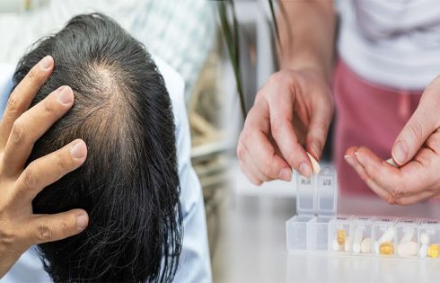 Best Vitamins to Address Hair Loss Caused by Nutritional Deficiencies