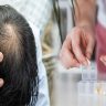 Best Vitamins to Address Hair Loss Caused by Nutritional Deficiencies