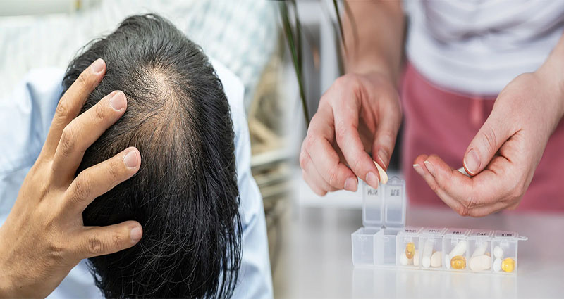 Best Vitamins to Address Hair Loss Caused by Nutritional Deficiencies