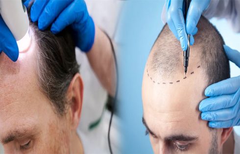 Factors Affecting the Success Rate of Hair Transplant Procedures