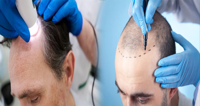 Factors Affecting the Success Rate of Hair Transplant Procedures