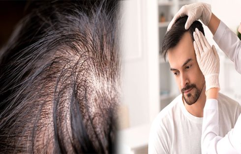 How to Identify Vitamin Deficiencies that Cause Thinning Hair and Hair Loss