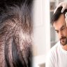 How to Identify Vitamin Deficiencies that Cause Thinning Hair and Hair Loss