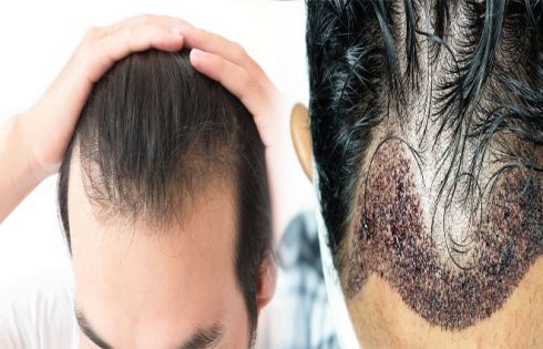 How to Improve Hair Transplant Success Rate with Pre and Post-Care