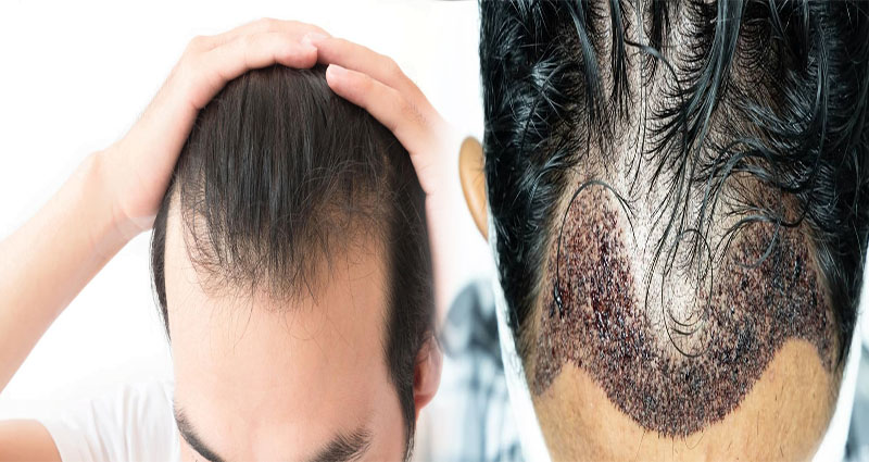 How to Improve Hair Transplant Success Rate with Pre and Post-Care