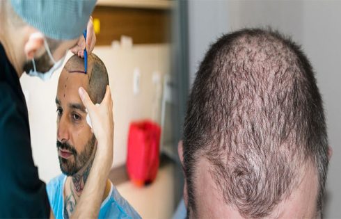 The Average Success Rate of Hair Transplants for Male Pattern Baldness