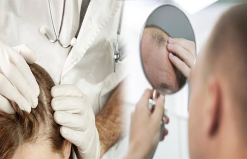 Unlocking Hair Transplant Success: Understanding the Impact of Hair Types and Densities