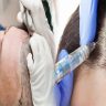 What to Expect Regarding Success Rate and Results from a Hair Transplant